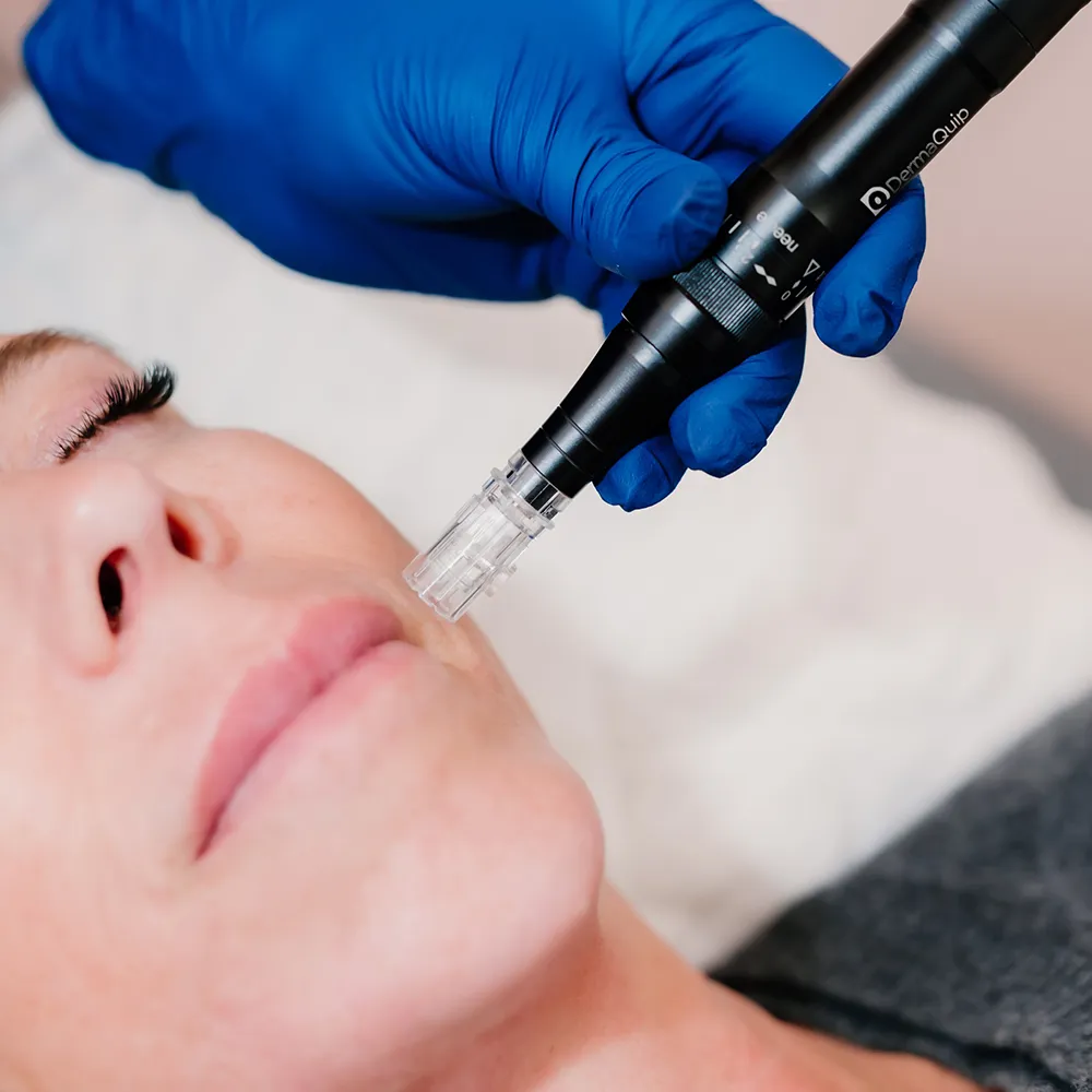 Microneedling