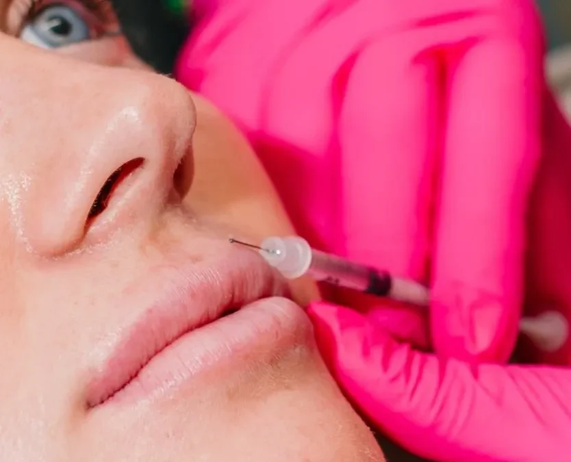 How Lip Fillers Restore Youthful Volume and Smooth Fine Lines